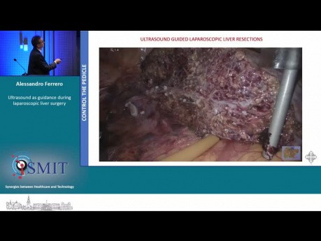 Ultrasound as Guidance During Laparoscopic Liver Surgery