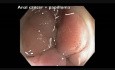 Colonoscopy Channel - Anal Papilloma and Cancer