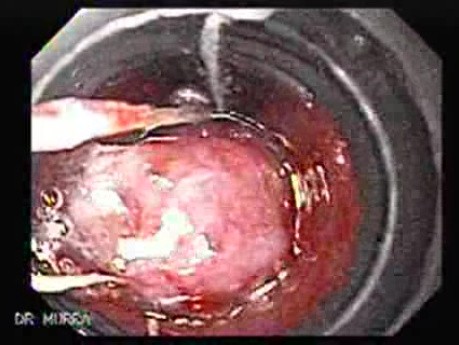 Hyperplastic Polyps - Endoscopy (7 of 14)