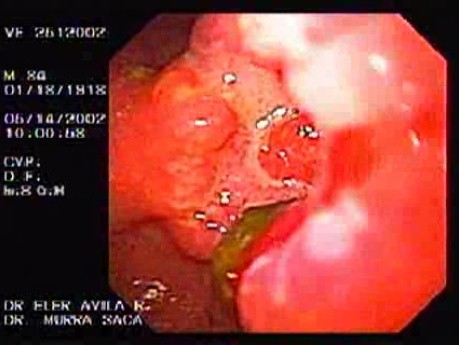 Ulcerative Gastric Carcinoma - Endoscopy