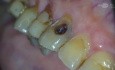 Buccal Maxillary Canine Access