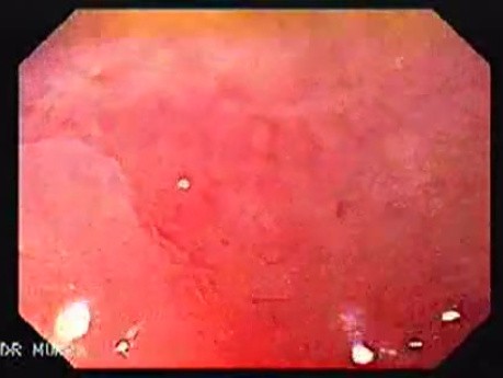 Barrett Esophagus (3 of 6)