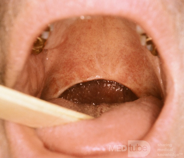 Postop Uvulopalatoplasty