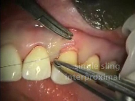 Periodontal Microsurgery: AlloDerm Grafting