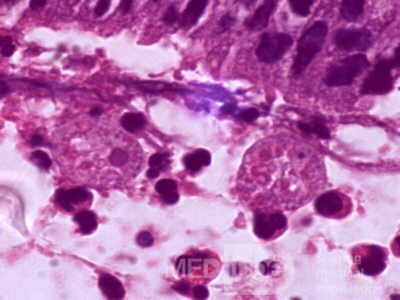 Entamoeba Histolytica