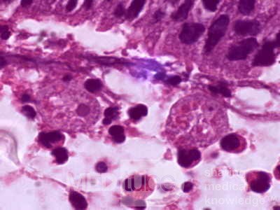 Entamoeba Histolytica