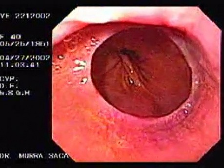 Hiatus Hernia with Schatzki Ring.