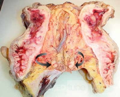 Rectal Adenocarcinoma (5 of 7)