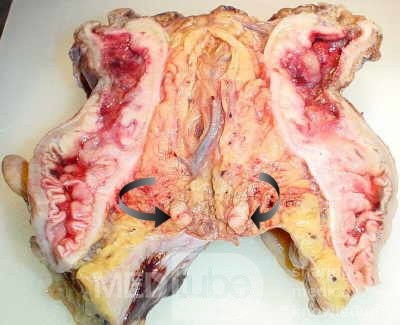 Rectal Adenocarcinoma (5 of 7)