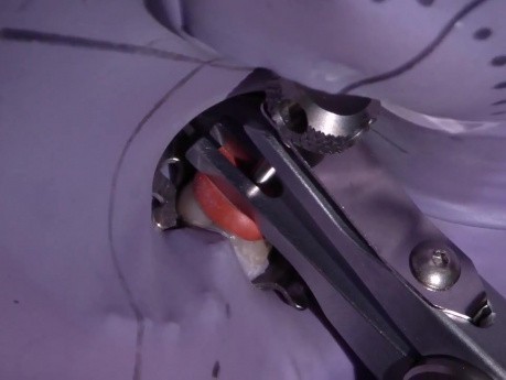Para Post Removal Using The Ruddle System