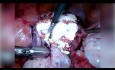TachoSil for Better Haemostasis and Suture Support After Laparoscopic Myoma Enucleation