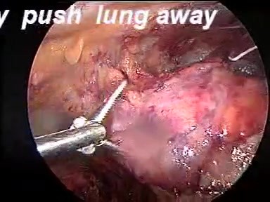 VATS- thymectomy anatomy