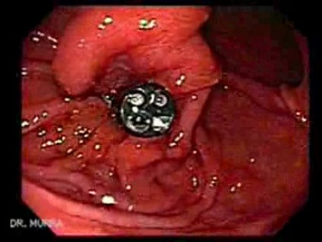 Withdrawal Of The Retrograde Endoscope - View From The Endoscope Introduced Classically - 2/2