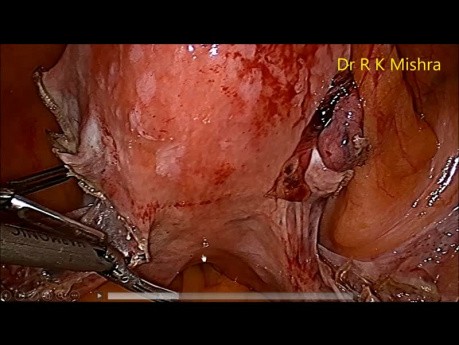 DR R K Mishra Live Stream Lecture on Total Laparoscopic Hysterectomy
