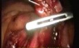 Laparoscopic Para-Aortic Lymphnode Dissection