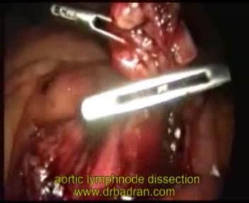 Laparoscopic Para-Aortic Lymphnode Dissection