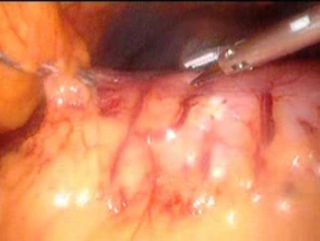 Gastrointestinal Stromal Tumor - GIST (16 of 65)