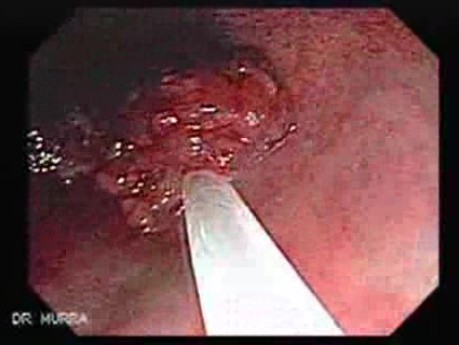Tubulo - Villous Rectal Adenoma - Endoscopy (9 of 35)