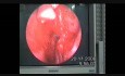 Bullet in the Ethmoid Sinus
