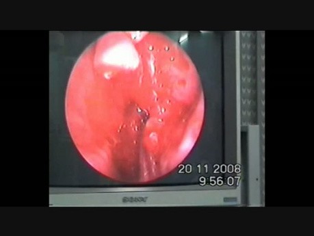 Bullet in the Ethmoid Sinus