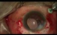 Scleral Tuck
