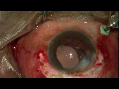 Scleral Tuck