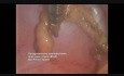 Single Incision Laparoscopic Appendectomy (SILA)