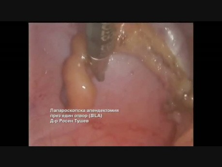 Single Incision Laparoscopic Appendectomy (SILA)