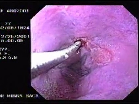 Hemorrhage due status post rubber band ligation of esophageal varices (8 of 25)