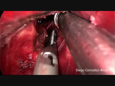 Left Lower Lobectomy by Means of Single Port VATS (Fisureless Technique)