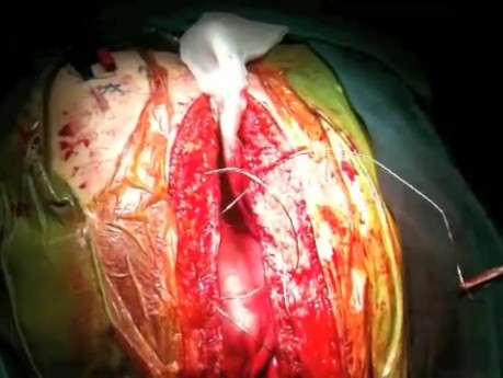 Median Sternotomy Closure Technique