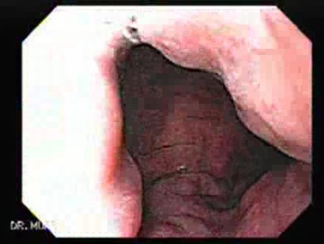 Gastric Varices (3 of 25)