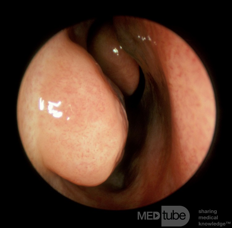 Vasoconstricted Inferior Turbinate [left]