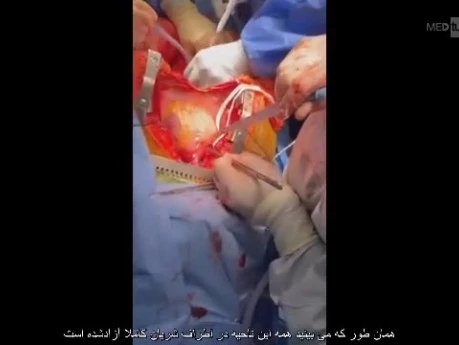 Complex Multi Organ Donation Version 2 - Another Aspect
