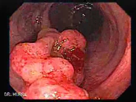 Colonoscopic Polypectomy (2 of 18)