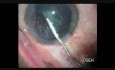  Oval Rhexis with Fugo Blade in PPC