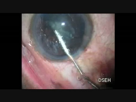  Oval Rhexis with Fugo Blade in PPC