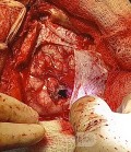 Surgical Planning with Neuronavigator in Patient with Intracranial Mass Lesion. High Grade Glioma.