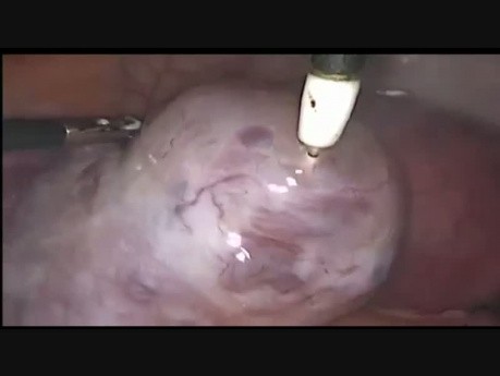 OHHS in IVF with Gangren of Right Ovary