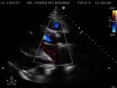 A Cardiology Case of a Postoperative Pericardial Effusion. The Chest X Ray, Echocardiography and Treatment Are Being Shown