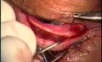 Entropion surgery for upper lid using Fugo Blade
