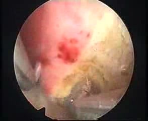 New Resection Master Systeme And Endometrial Ablation