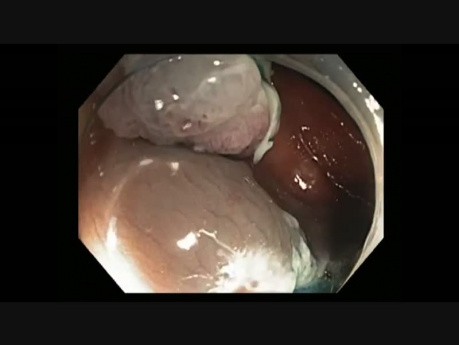 Colonoscopy - Descending Colon Flat Lesion - En-bloc EMR
