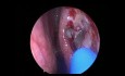 Endoscopic DCR