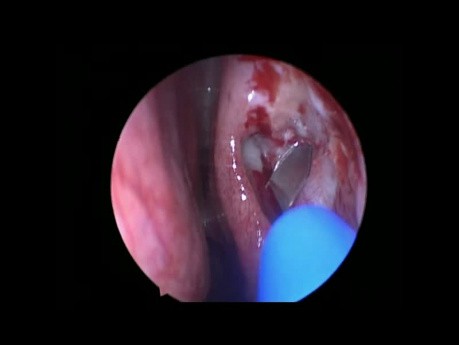 Endoscopic DCR