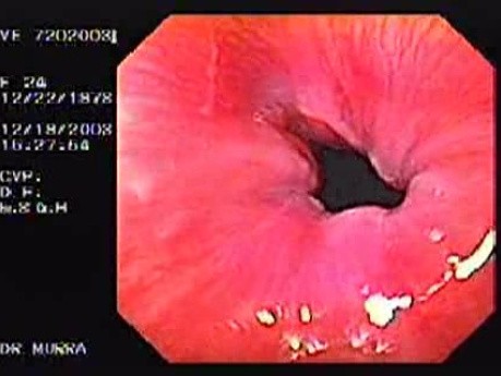 Flexible Endoscopic Suturing - 24 Years-Old Female
