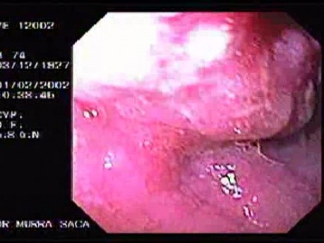Malignant Gastric Glandular Neoplasia - Intestinal Type