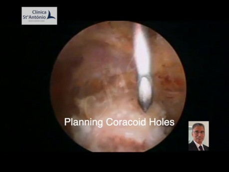 Arthroscopic Latarjet (@Latarjet) - Left Shoulder Anterior Recurrent Dislocation
