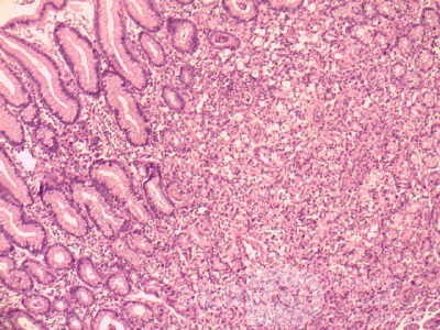 Gastric Cancer (13 of 15)