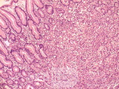Gastric Cancer (13 of 15)